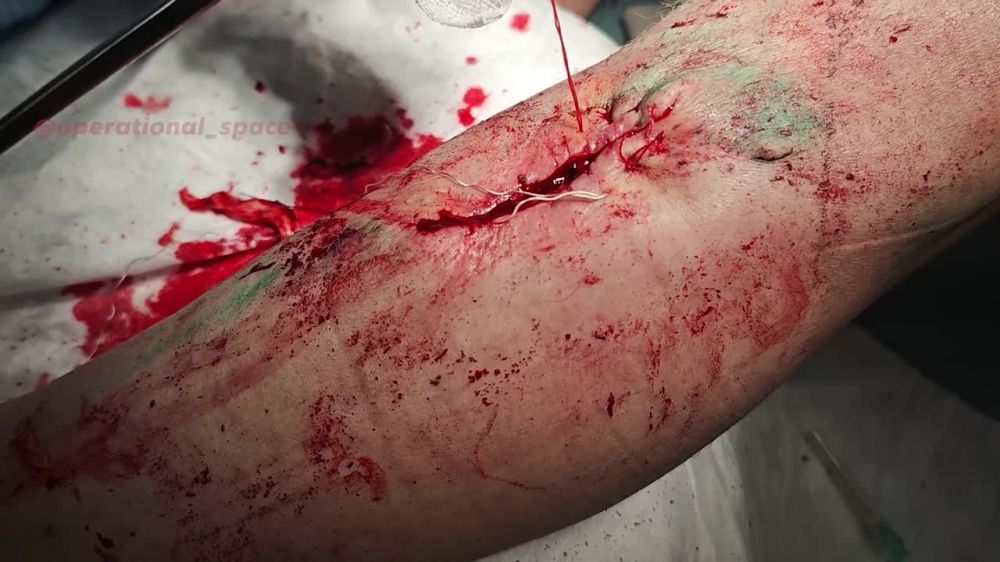 Старшая операционная сестра госпиталя #25_армии с позывным "Луна" поделилась своим боевым опытом